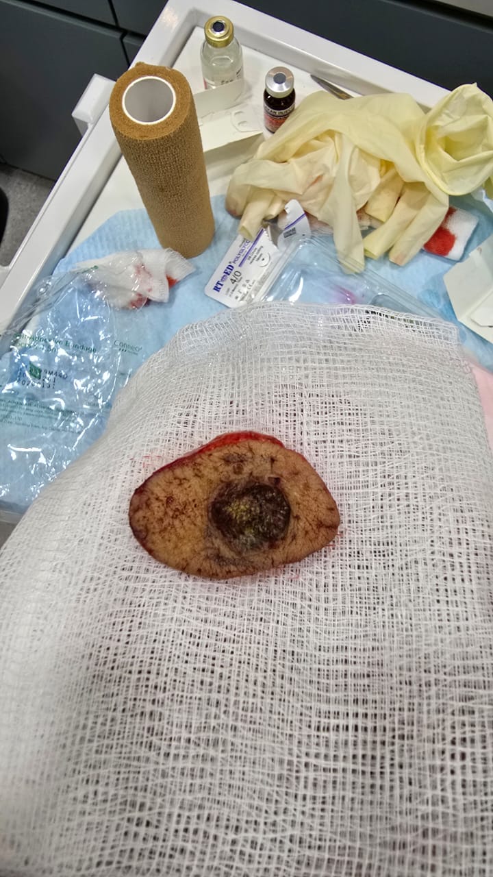 Bowen disease excised tissue specimen